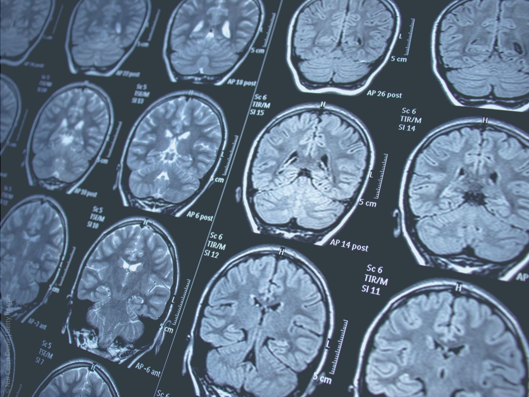 Je früher die Diagnosestellung, desto besser